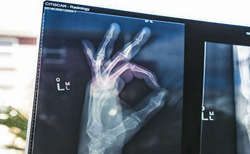 A gyermekkori csonttöréseknél eredményesen alkalmazhatóak a felszívódó rögzítések